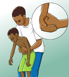 How to give abdominal thrusts to an older child