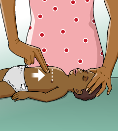 How to give chest thrusts to a choking infant